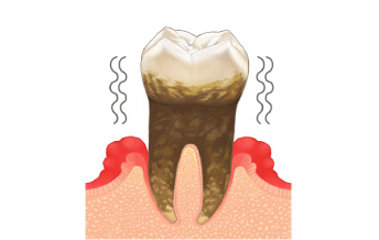 イラスト図：重度歯周病